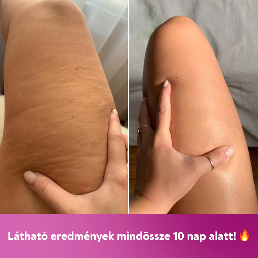 60 napos cellulitisz elleni terápia  + Zsibbasztó spray 